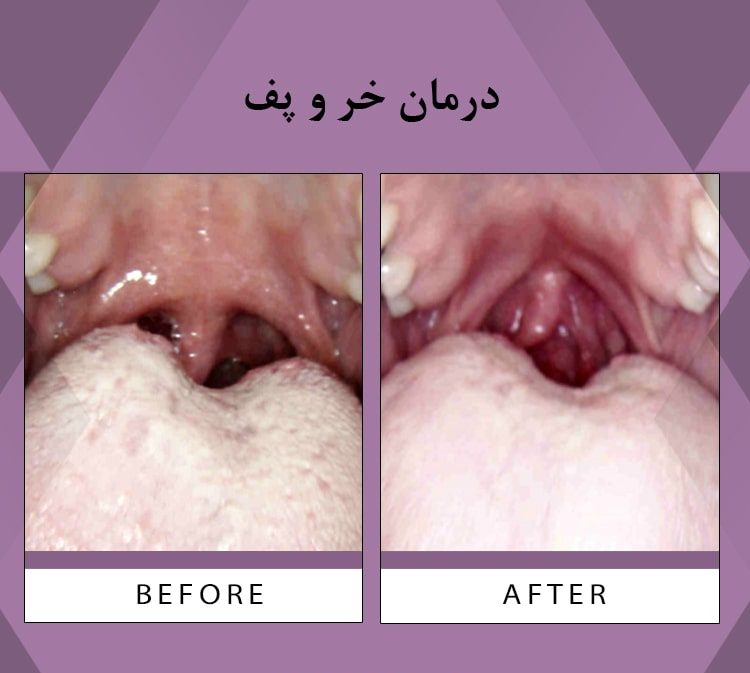 درمان خروپف